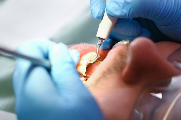 Best Broken or Cracked Tooth Emergency Dentist in La Presa, CA